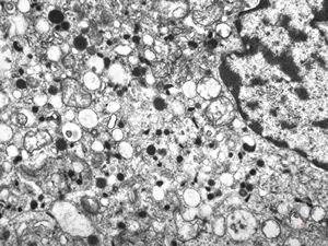 M, 38y. | pheochromocytoma